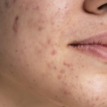 Dermatologist debunks ‘five common myths’ around acne and reveals what really triggers adult breakouts: ‘What you eat is not the cause’