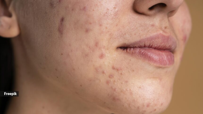 Dermatologist debunks ‘five common myths’ around acne and reveals what really triggers adult breakouts: ‘What you eat is not the cause’