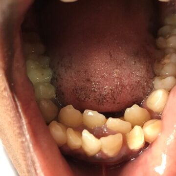 This rare condition left an 11-year-old with 81 teeth; dentist says ‘most people don’t realise until…’