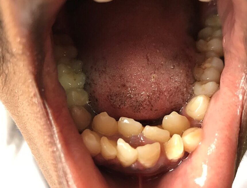 This rare condition left an 11-year-old with 81 teeth; dentist says ‘most people don’t realise until…’ This rare condition left an 11-year-old with 81 teeth; dentist says ‘most people don’t realise until…’