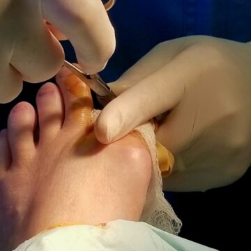 Expert shares case of 56-year-old diabetic patient who hid shoe bite for 3 weeks: ‘I didn’t want to burden them’