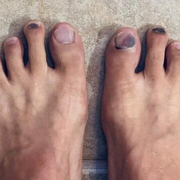 ‘I have dried blood in my toenail. It’s been 7 months. How do I take it out?’