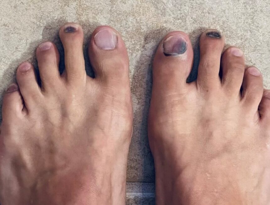 ‘I have dried blood in my toenail. It’s been 7 months. How do I take it out?’