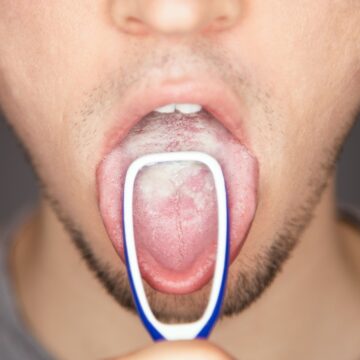 This is what happens when you do not clean your tongue for a month