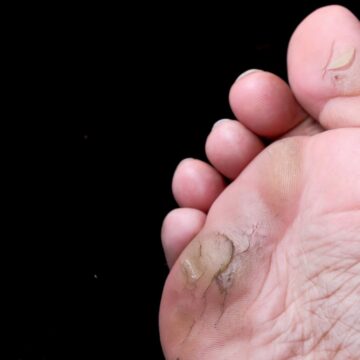 Why does the skin of your foot get so hard and thick?