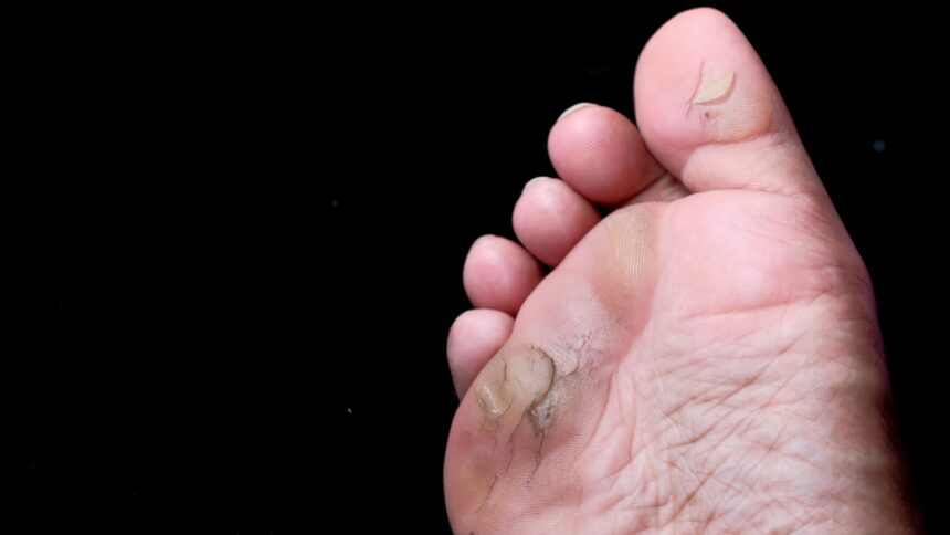 Why does the skin of your foot get so hard and thick?