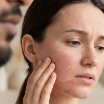 ‘Have you ever experienced beard burn?’: Doctor explains why a kiss can cause redness and itching; a dermatologist verifies