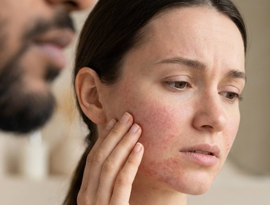 ‘Have you ever experienced beard burn?’: Doctor explains why a kiss can cause redness and itching; a dermatologist verifies ‘Have you ever experienced beard burn?’: Doctor explains why a kiss can cause redness and itching; a dermatologist verifies