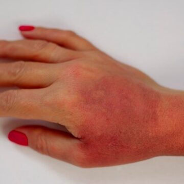 Why this common burn remedy is actually dangerous