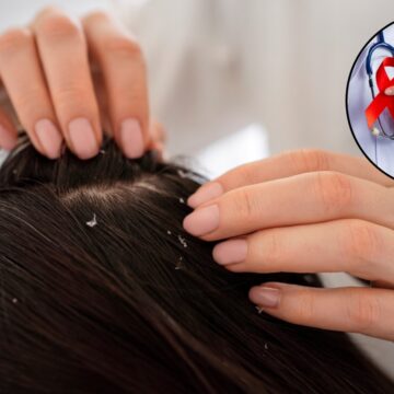 Can seborrheic dermatitis or dandruff be a hidden sign of HIV? Expert weighs in on viral claim
