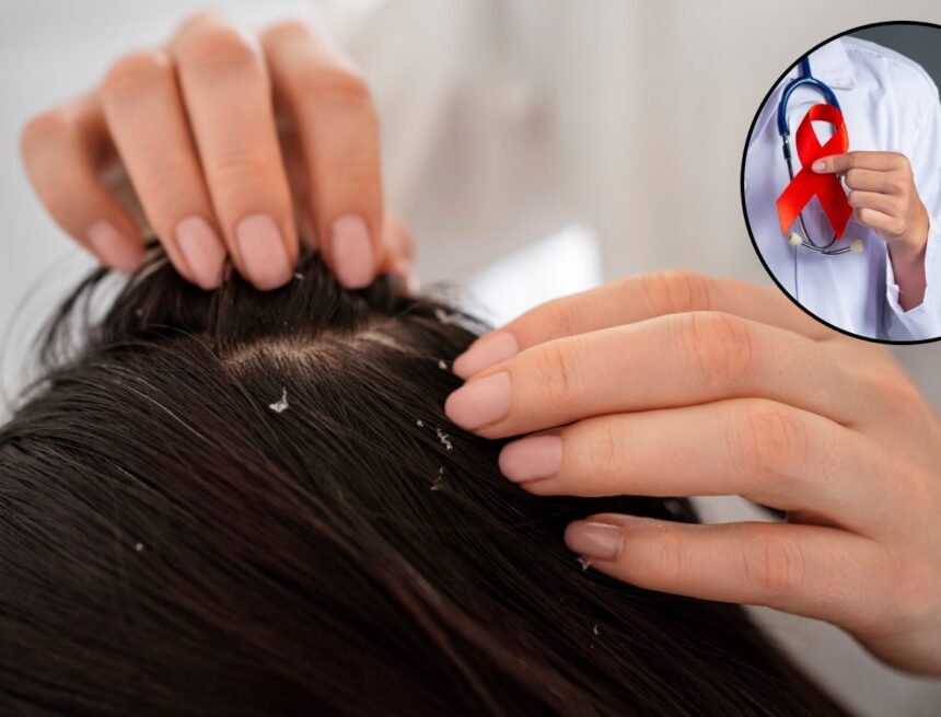 Can seborrheic dermatitis or dandruff be a hidden sign of HIV? Expert weighs in on viral claim Can seborrheic dermatitis or dandruff be a hidden sign of HIV? Expert weighs in on viral claim