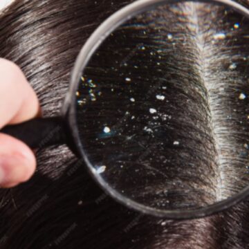 Does shaving your head cure dandruff? Expert weighs in