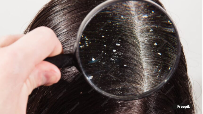 Does shaving your head cure dandruff? Expert weighs in