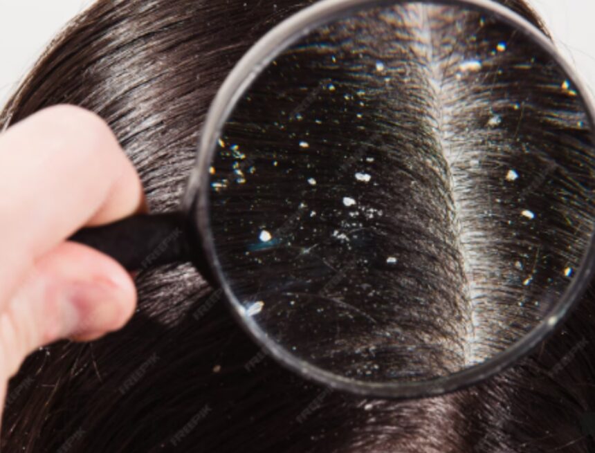 Does shaving your head cure dandruff? Expert weighs in