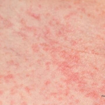 No, it’s not contagious: Debunking common myths about summer heat rash