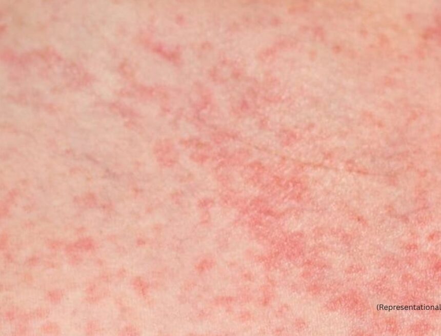 No, it’s not contagious: Debunking common myths about summer heat rash