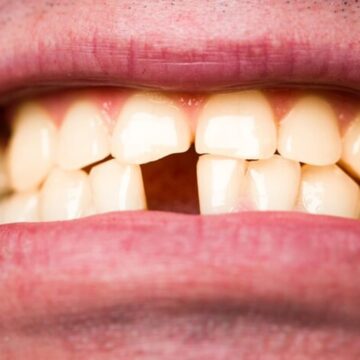 The 1.7% risk: How every lost tooth impacts cognitive longevity