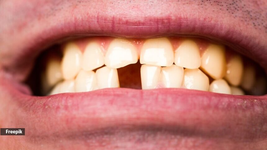 The 1.7% risk: How every lost tooth impacts cognitive longevity