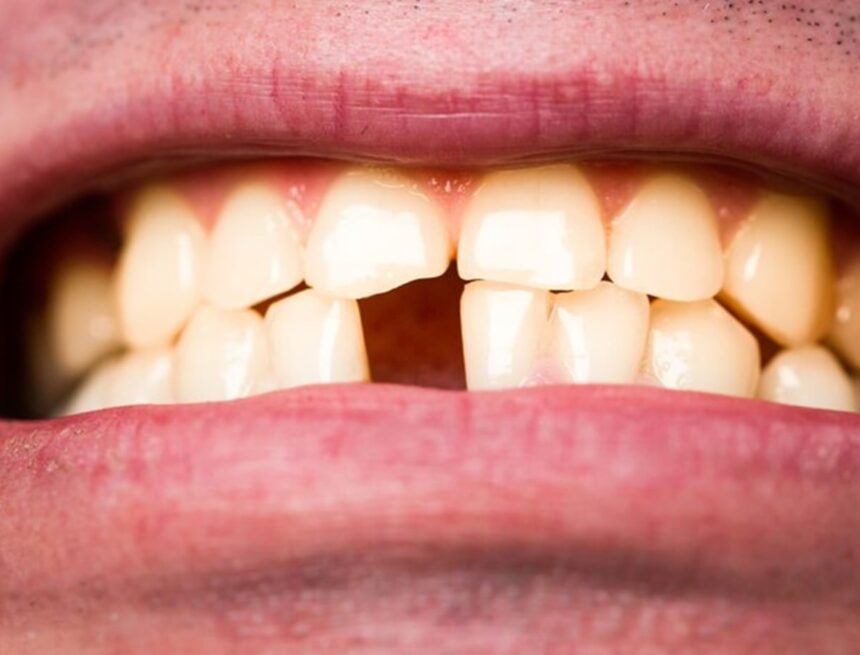 The 1.7% risk: How every lost tooth impacts cognitive longevity