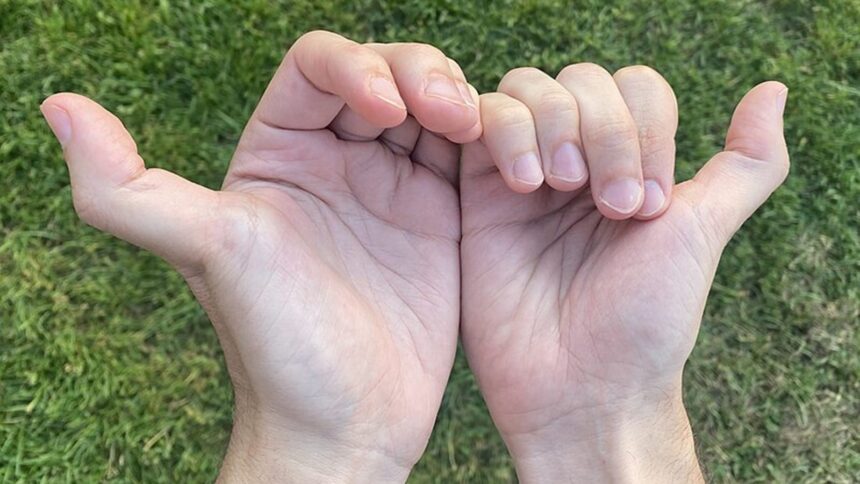 Why ‘double-jointed’ isn’t always a health win Why ‘double-jointed’ isn’t always a health win