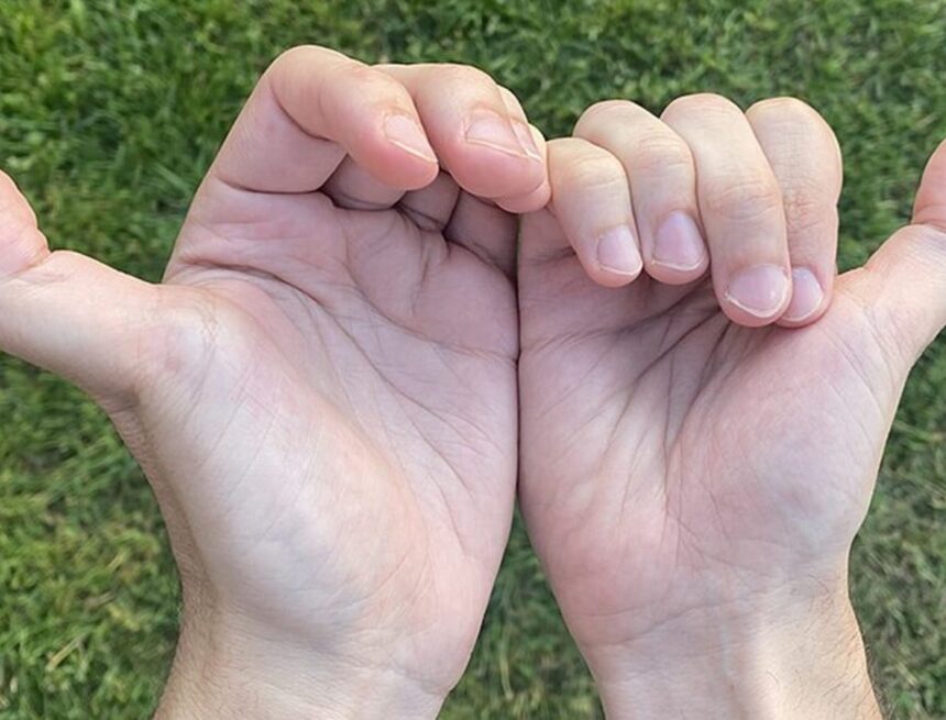 Why ‘double-jointed’ isn’t always a health win