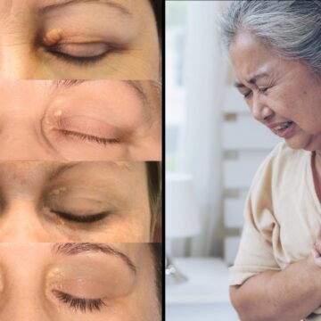 Xanthelasma: Why those tiny yellow eyelid deposits matter for your heart
