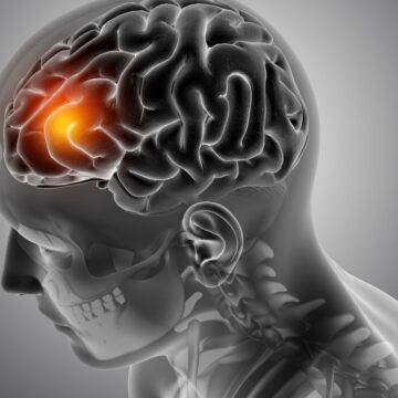 1 In 7 stroke patients in India are between ages 18-44: Here’s what happens if you reach hospital after 24 hours of symptom onset