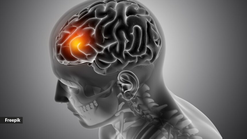 1 In 7 stroke patients in India are between ages 18-44: Here’s what happens if you reach hospital after 24 hours of symptom onset
