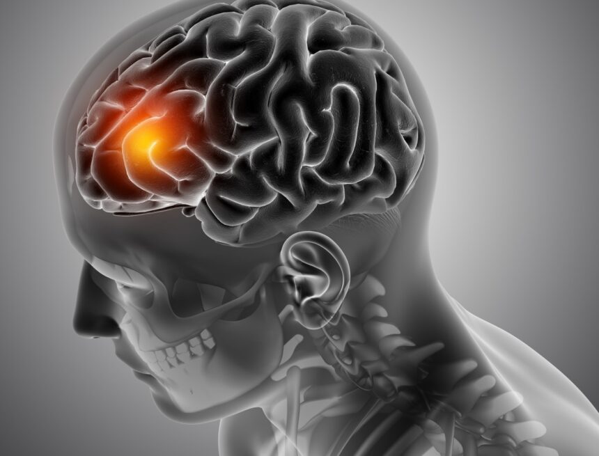 1 In 7 stroke patients in India are between ages 18-44: Here’s what happens if you reach hospital after 24 hours of symptom onset