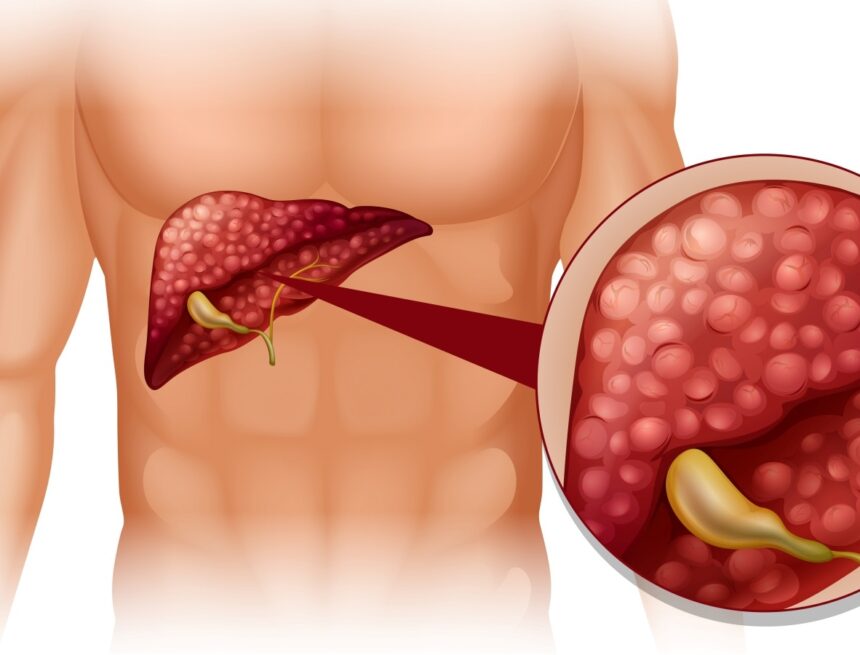 ‘I am newly diagnosed with cirrhosis. Can it be reversed?’