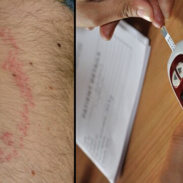 ‘Early signs are often subtle’: This is what a diabetic skin rash looks like