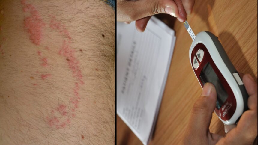 ‘Early signs are often subtle’: This is what a diabetic skin rash looks like