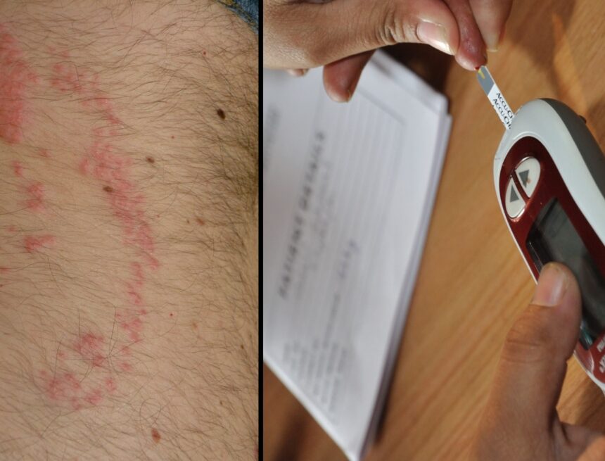 ‘Early signs are often subtle’: This is what a diabetic skin rash looks like