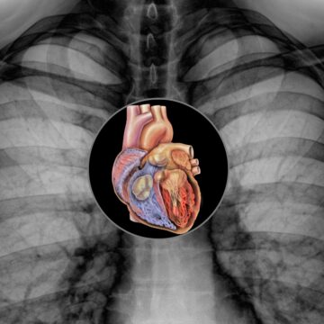‘It was found in an X-ray that my heart is bigger than normal, but doctor said it was just fine. What factors could make heart enlargement turn out to be fine?’