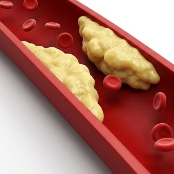 Doctor shares habits that may naturally help lower ‘bad’ cholesterol