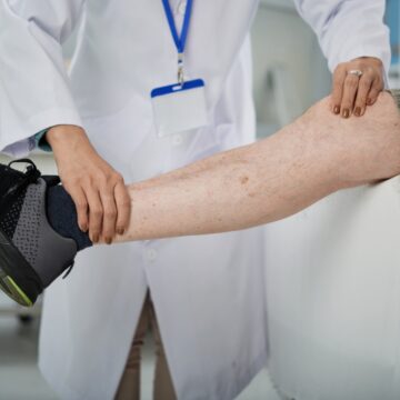 ’25–30% of Indians have varicose veins’: Here’s when you should get a Doppler Test