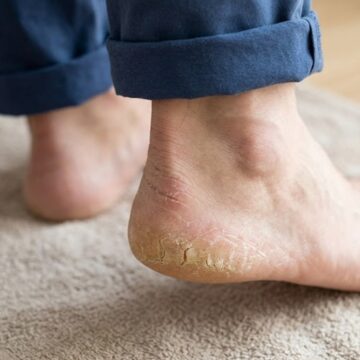 Why cracked heels are usually not a sign of zinc deficiency Why cracked heels are usually not a sign of zinc deficiency
