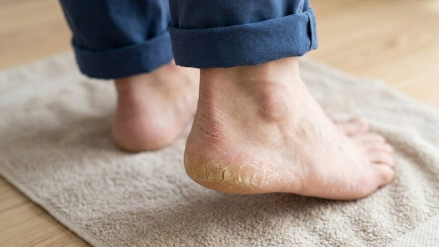 Why cracked heels are usually not a sign of zinc deficiency Why cracked heels are usually not a sign of zinc deficiency