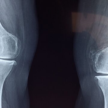 Why joint pain may worsen before it rains: ‘Barometric pressure can shift…’