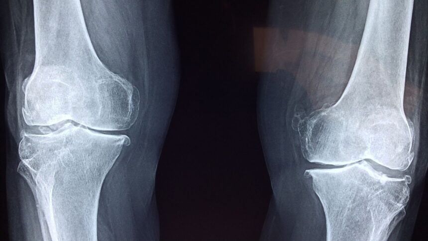 Why joint pain may worsen before it rains: ‘Barometric pressure can shift…’