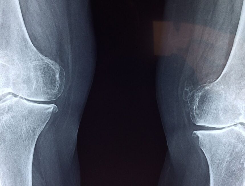 Why joint pain may worsen before it rains: ‘Barometric pressure can shift…’ Why joint pain may worsen before it rains: ‘Barometric pressure can shift…’