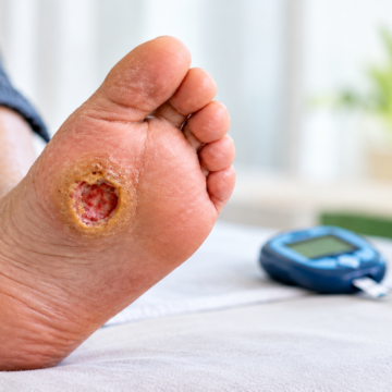‘Can a diabetic foot ulcer cause a bone infection?’ ‘Can a diabetic foot ulcer cause a bone infection?’