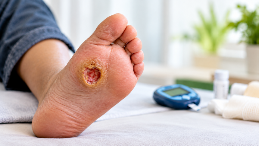 ‘Can a diabetic foot ulcer cause a bone infection?’ ‘Can a diabetic foot ulcer cause a bone infection?’