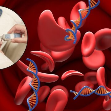 HbA1c and anaemia: Why your blood sugar test may not tell the full story